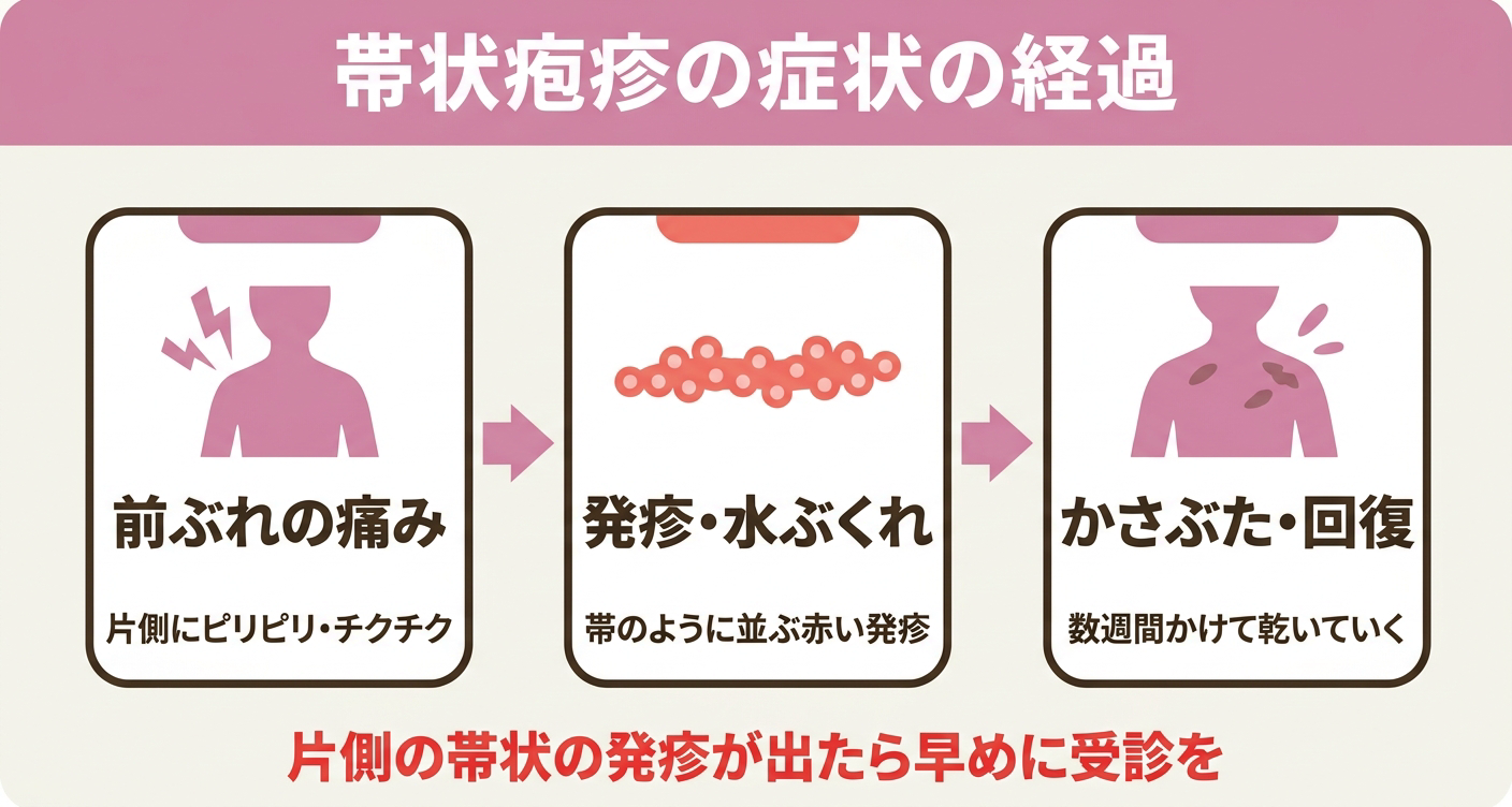帯状疱疹の症状の経過を「前ぶれの痛み」「発疹・水ぶくれ」「かさぶた・回復」の3ステップで整理した図解。片側の痛みが先に出て帯状の発疹へ進む流れを視覚的に示し、片側の帯状の発疹が出たら早めに受診することを促します。